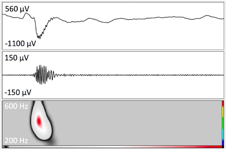 Exemple de biomarqueurs identifié par Halyzia (en haut signal EEG, au milieu signal EEG filtré, en bas signal représenté dans un plan temps-fréquence).